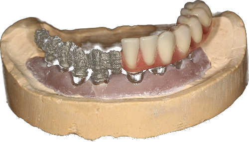 תותבת מוברגת SLM Co/Cr — שלד בלבד